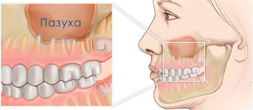 sinusita odontogena